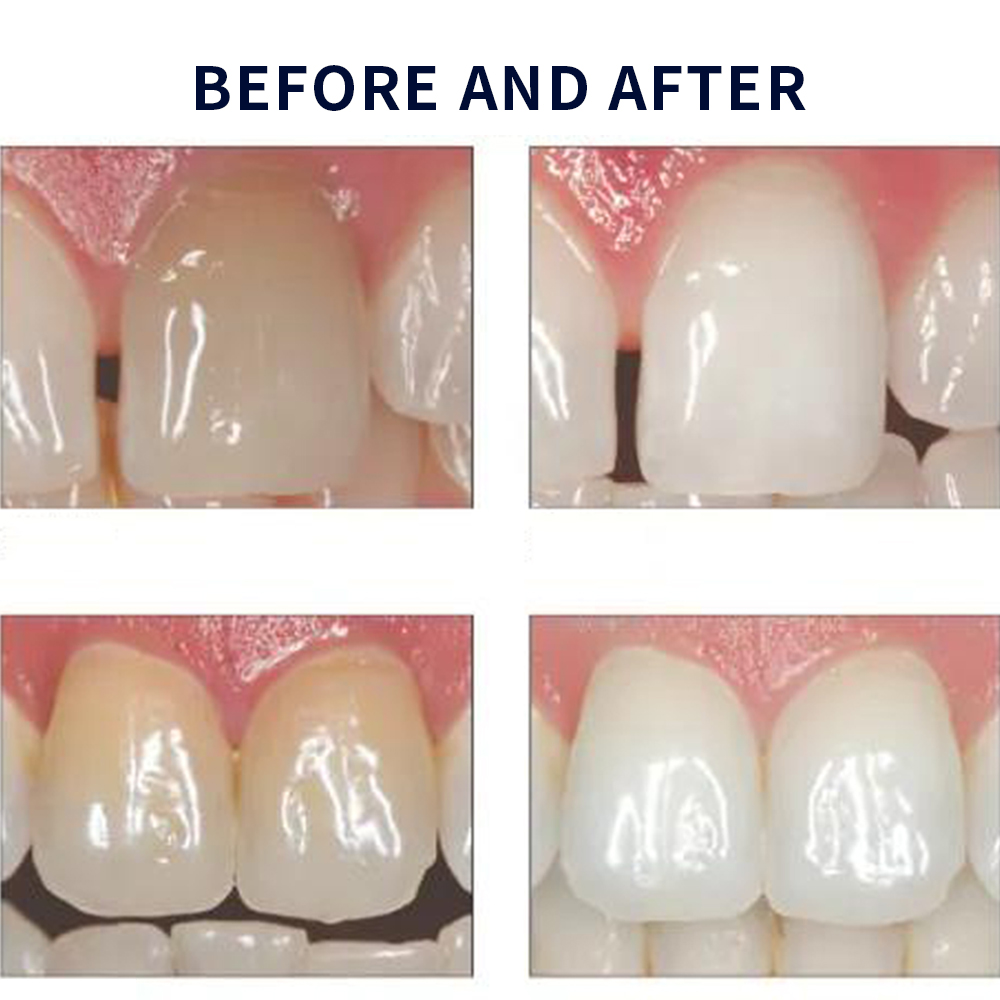 Отбеливающий набор opalution 2 – обзор и цена Teeth Whitening Near Me